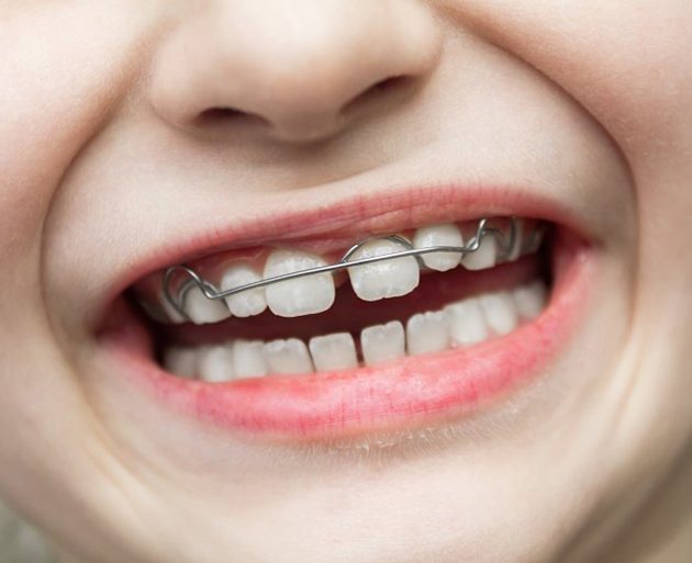 a girl smiling while visiting a dentist